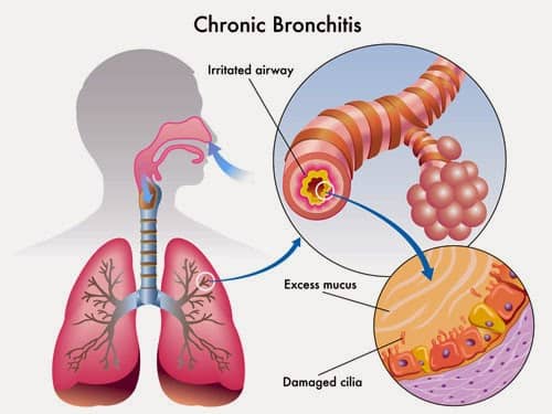 Cara alami mengobati bronkitis obat tradisional bronkitis