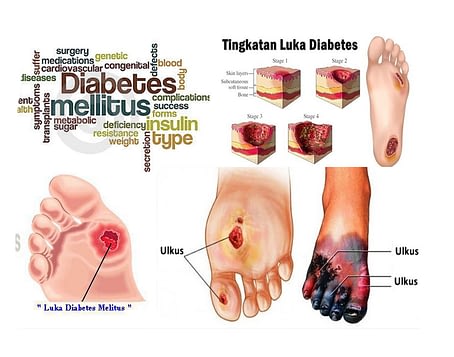 Okeman Obat Kencing Manis Diabetes-Melitus-8