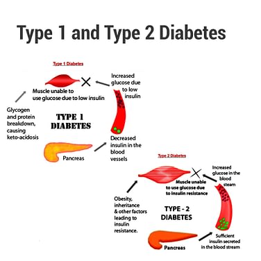 Okeman Obat Kencing Manis types of diabets
